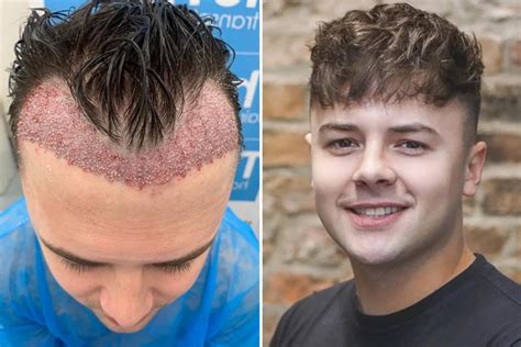 The average cost of a hair transplant in Turkey with Blue magic hair: What to expect.
